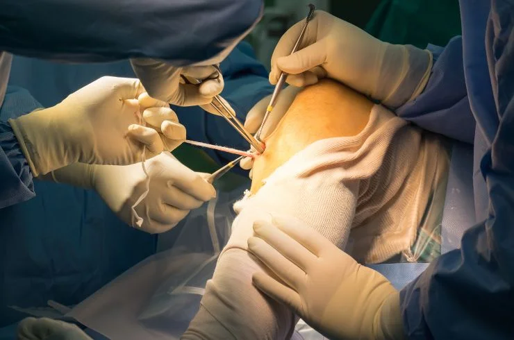 Dr. Paramjit Anterior cruciate ligament (ACL) reconstruction