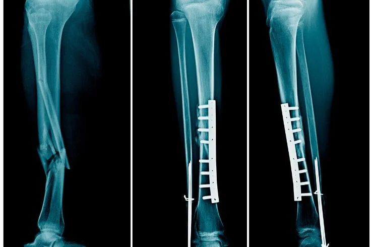 Dr. Paramjit Fracture fixation