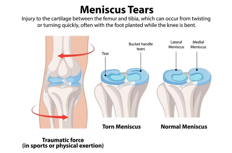 Dr. Paramjit Meniscus repair