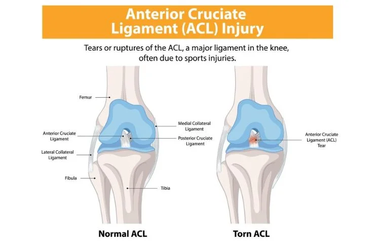 Dr. Paramjit Primary ACL repair