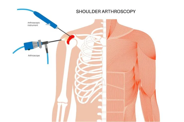 Dr. Paramjit Shoulder instability surgery