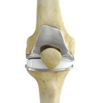 Total Knee Replacement