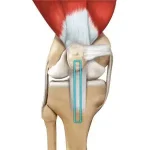 acl-reconstruction-patellar-tendon