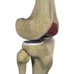 knee-arthritis