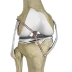 knee-ligament-reconstruction