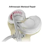 meniscal-repair-surgery