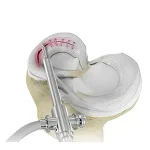 meniscal-surgery