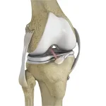 multiligament-knee-reconstruction