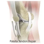 patellar-tendon-repair