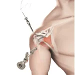 shoulder-arthroscopy