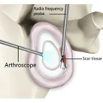 shoulder-capsular-release