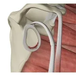 shoulder-labral tear