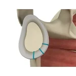 shoulder-labrum-reconstruction