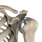 specific-shoulder-joint-replacement